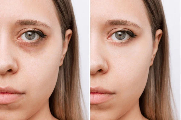 Under-eye area corrected with peach and orange color corrector before applying concealer.