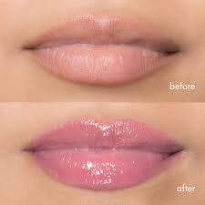 Can Lip Plumpers Replace Lip Fillers?